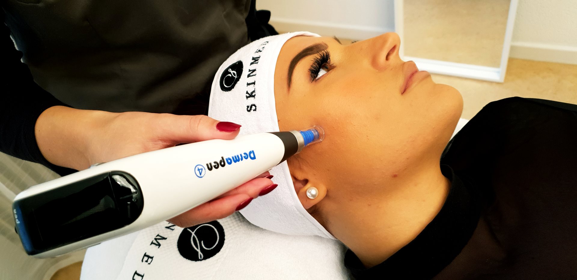 microneedling